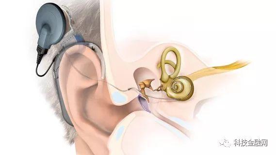 美国耳蜗最新款引领听力技术革新潮流